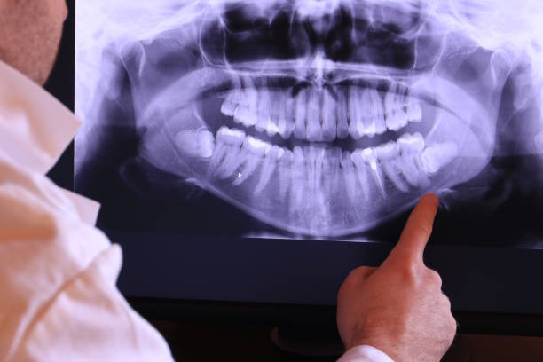 Best Emergency Wisdom Teeth Removal in Mpo, CA